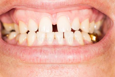 牙齿的面相男人牙齿缝隙大的人面相到感情看感情